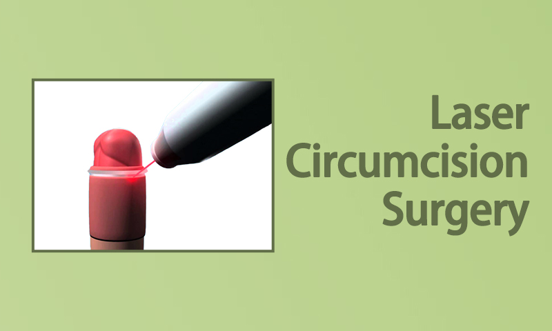 Laser Circumcision