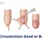 Is Circumcision Good or Bad