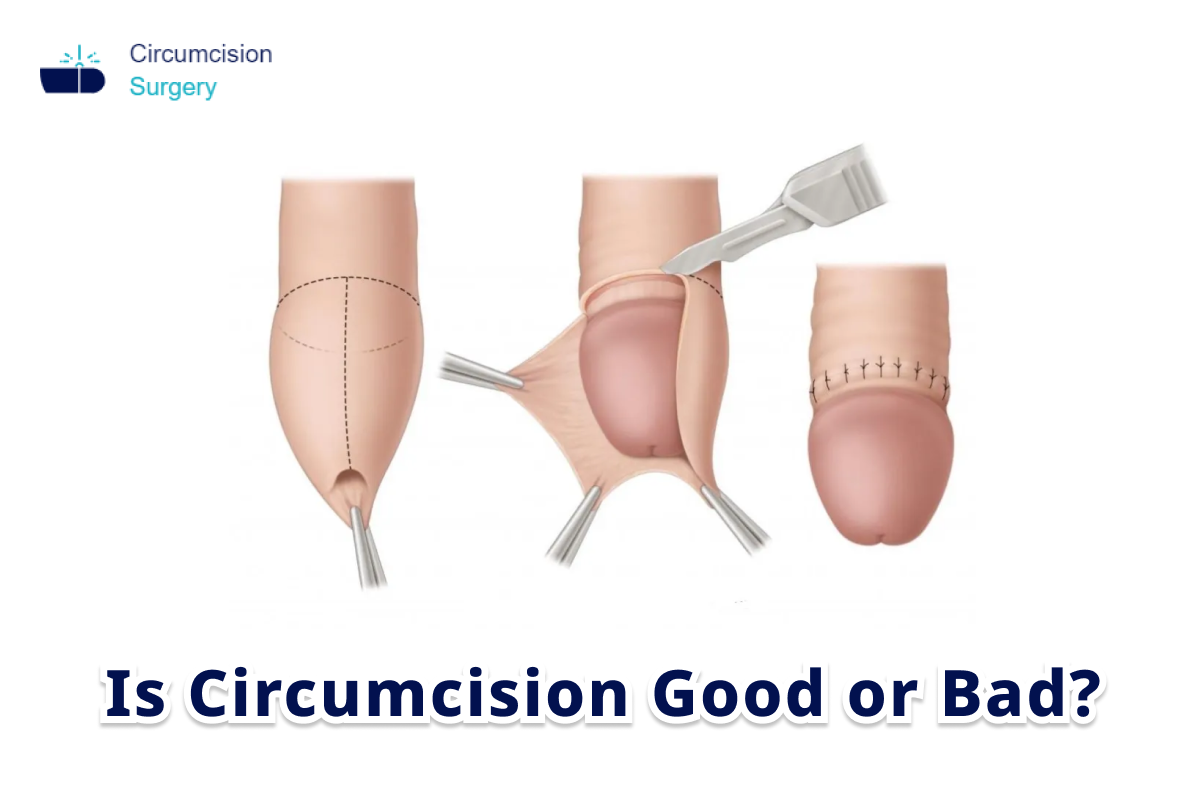 Is Circumcision Good or Bad