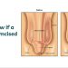 How-to-know-if-a-guy-is-circumcised-or-not